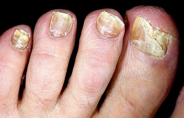 Чеснок против грибка ногтей на ногах и руках: лечение пластины настойкой на уксусе, соком, отваром и чаем, а также список противопоказаний