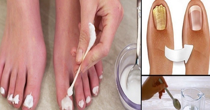 Чеснок против грибка ногтей на ногах и руках: лечение пластины настойкой на уксусе, соком, отваром и чаем, а также список противопоказаний